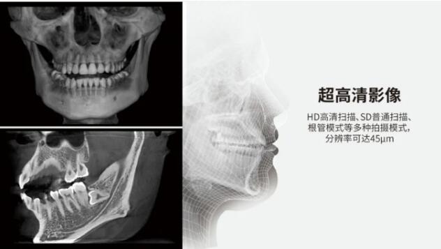 口腔CT植牙影像